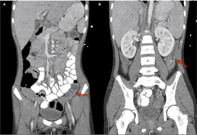 Recognizing a MIS-Chievous Cause of Acute Viral Gastroenteritis